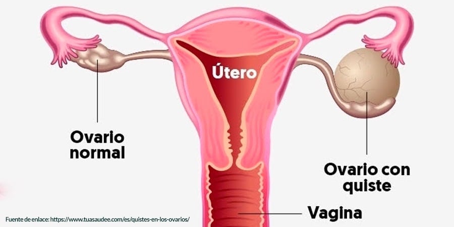 Cómo tomar Metformina para los Quistes en los Ovarios